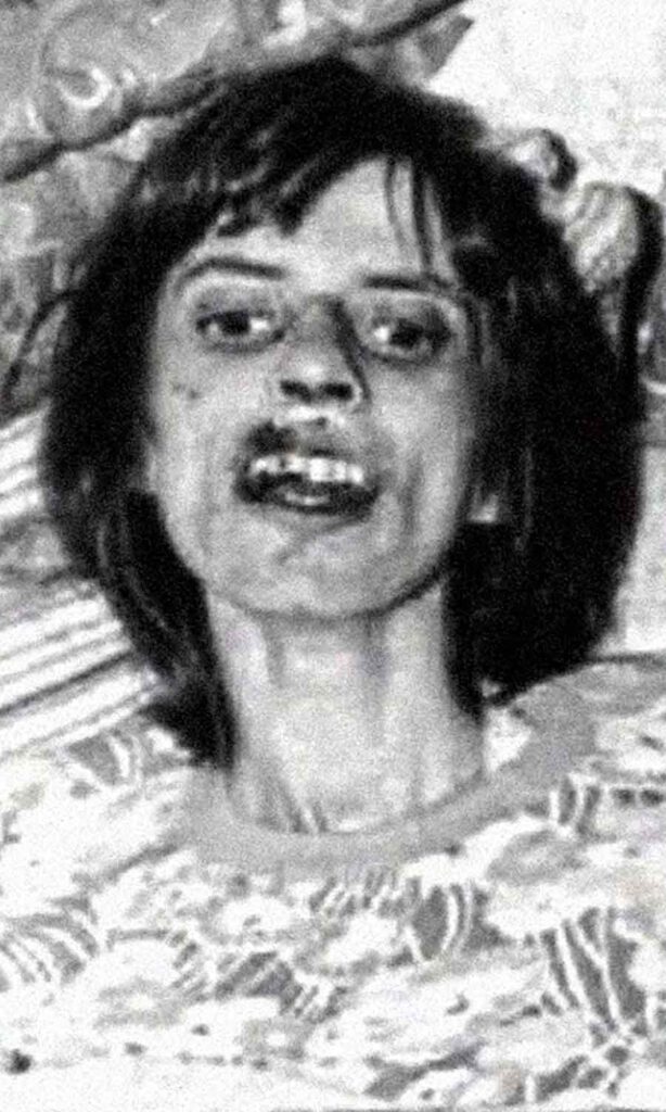 Fotografía en blanco y negro de Anneliese Michel víctima de una posesión demoníaca durante una de las 67 sesiones de exorcismo realizadas entre 1975 y 1976. La imagen muestra su grave deterioro físico, con el rostro demacrado y expresión de sufrimiento, reflejo del proceso extremo al que fue sometida.